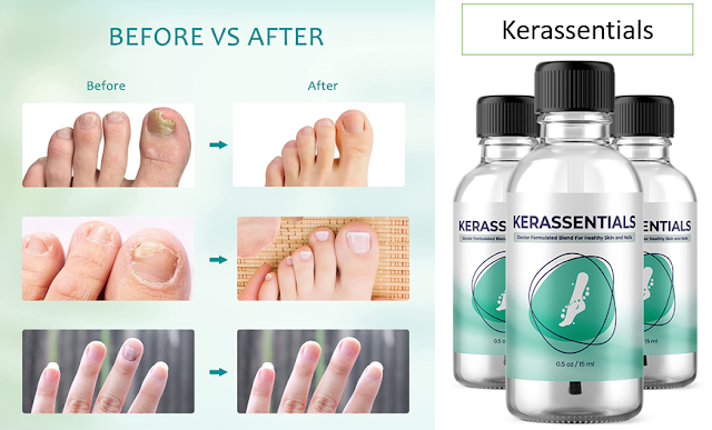 Kerassentials Review – Treating a Fungal Nail Infection