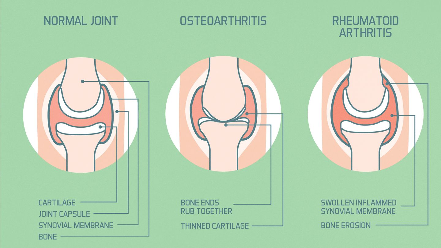 Osteoarthritis and Rheumatoid Arthritis